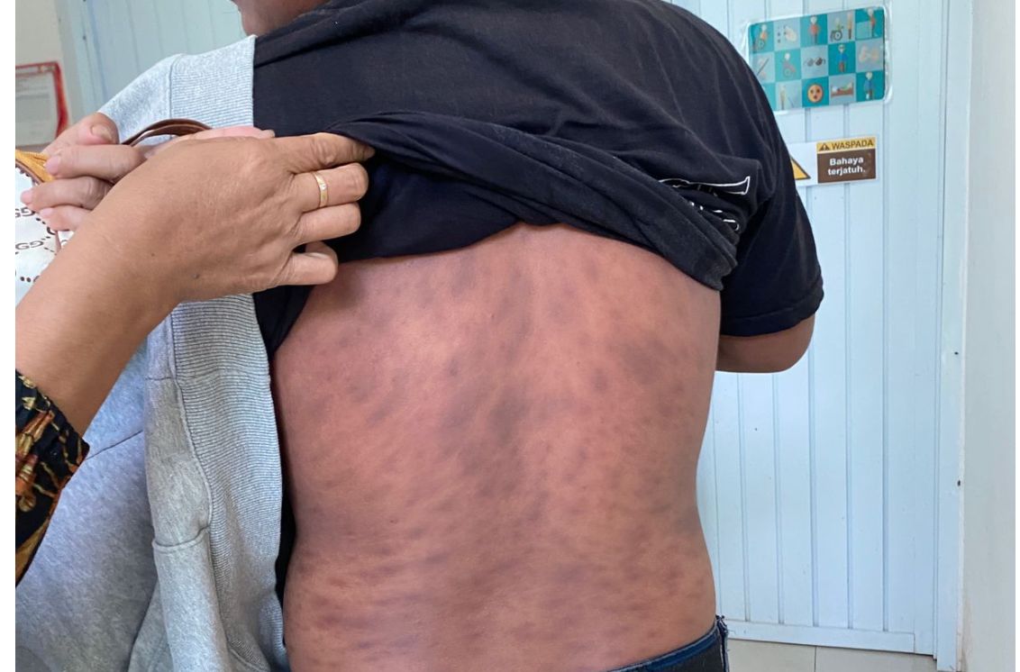 Prevalensi Kusta di Sulawesi Barat Masih Tinggi, Dinkes Perkuat Deteksi Dini dan Pengobatan